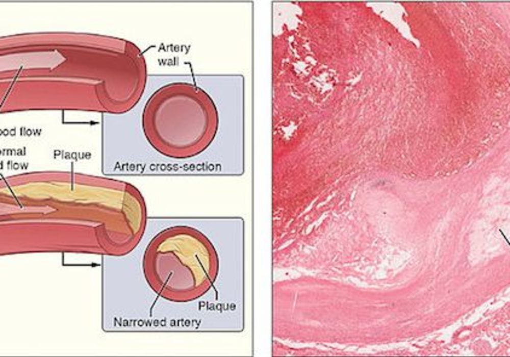 Imaging IDs People at Risk for Stroke