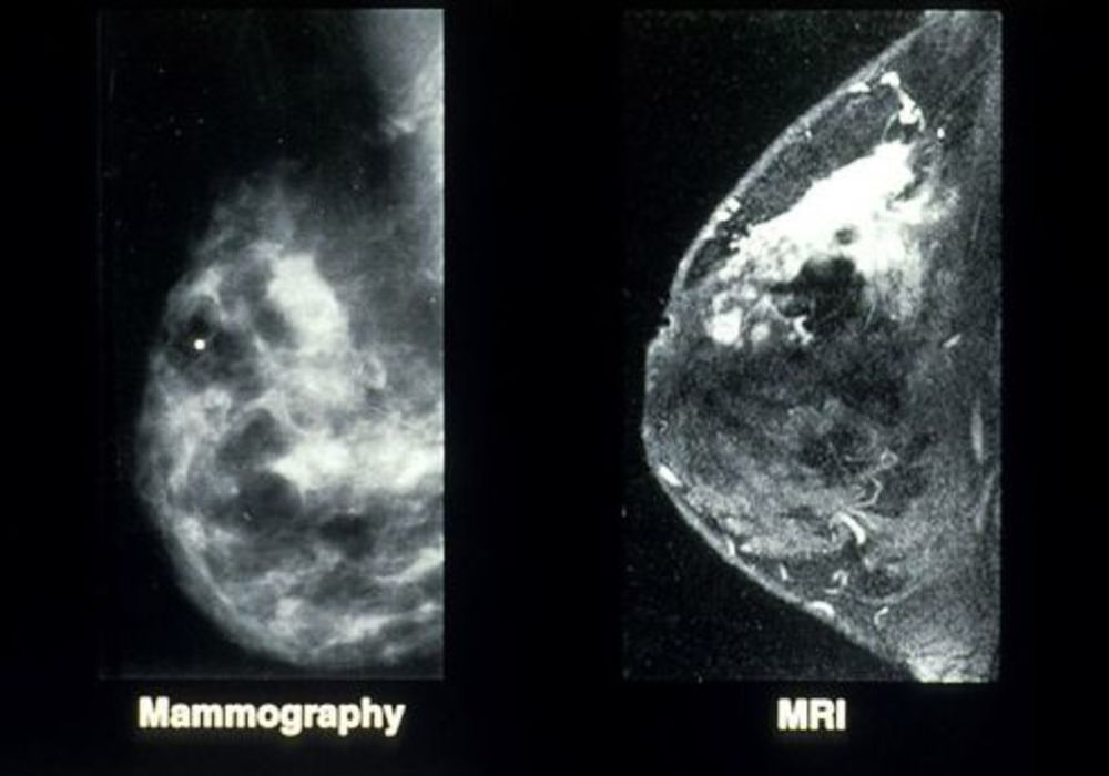 3-Minute Breast MRI &#039;Better than Mammography&#039;