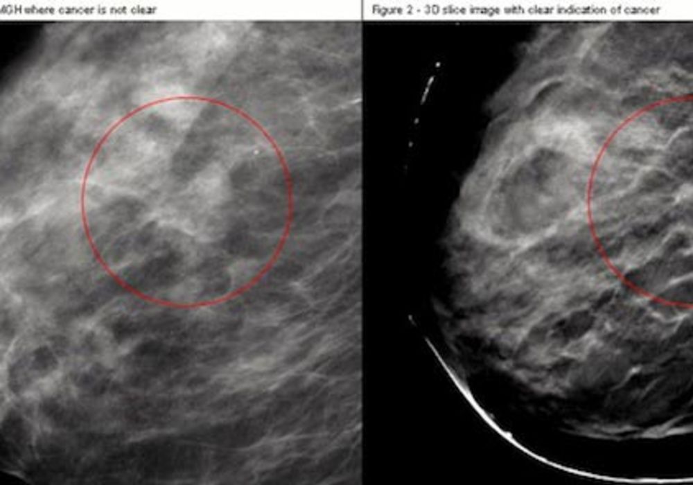 3-D Breast Imaging Improves Mammography Accuracy 