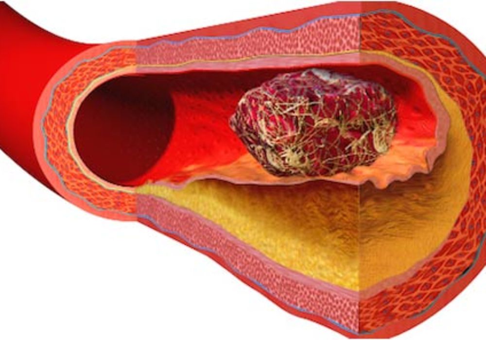 STEMI Strategies: Personalised Patient Plans are Optimal