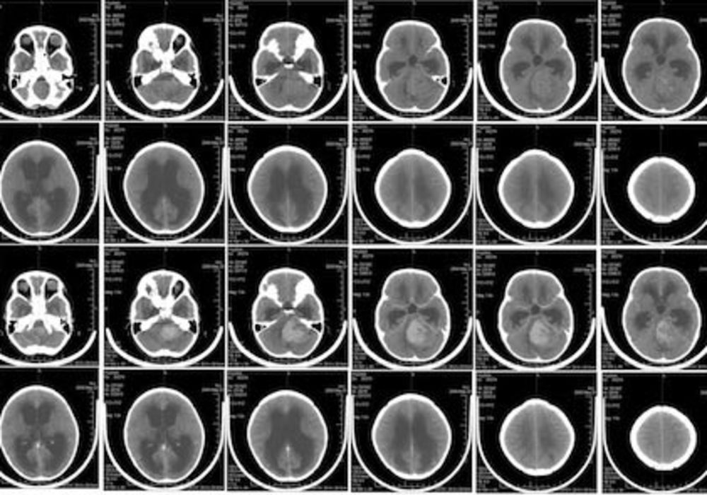 Radiation Risks in Paediatric CT: An Evaluation