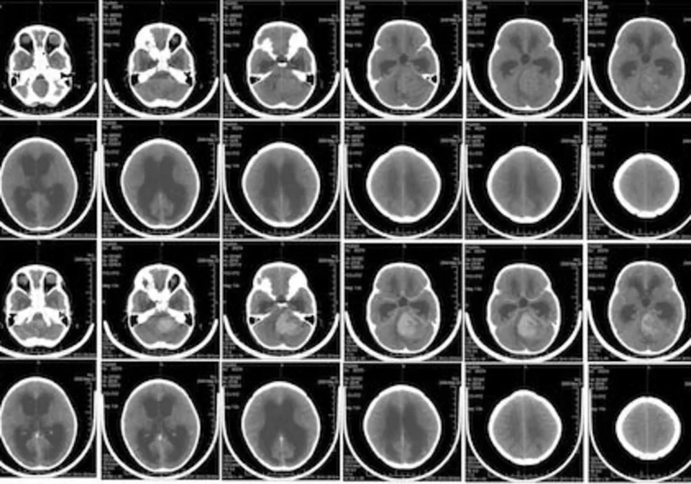 Radiation Risks in Paediatric CT: An Evaluation