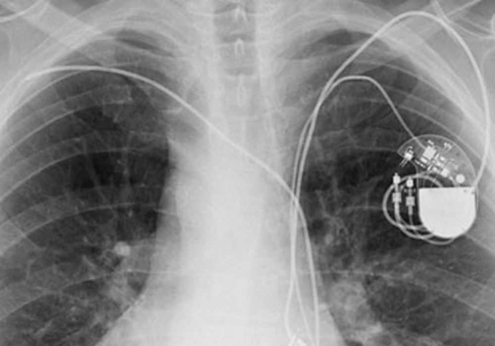 Study: Defibrillator Testing Prior to ICD Procedure Unnecessary