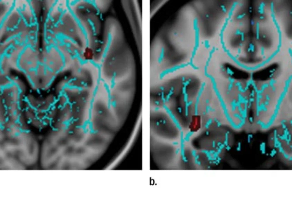 Concussions: Men Have Longer Recovery Time 