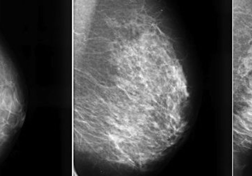 Breast Tissue Density Irrelevant for Molecular Imaging