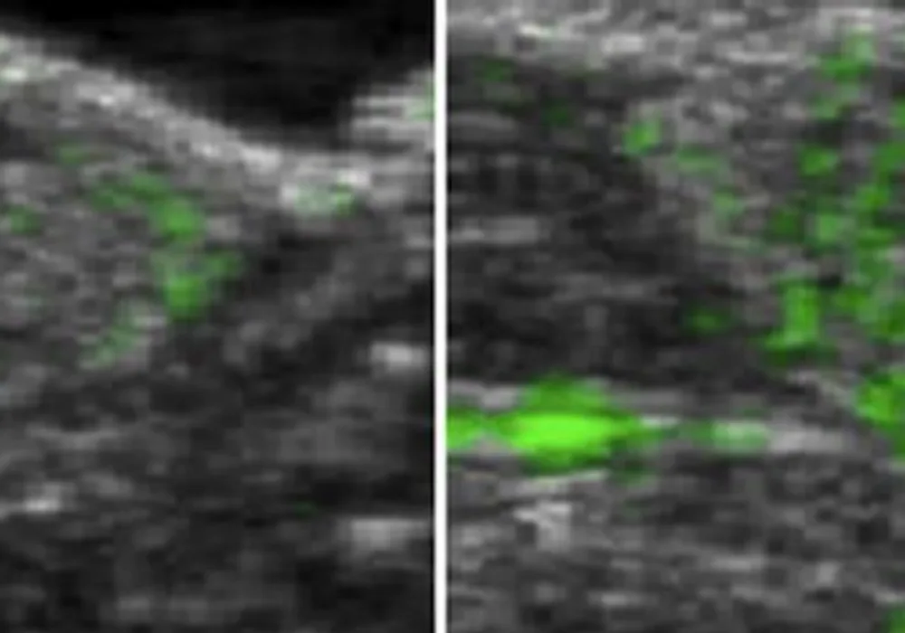 Improved Ultrasound Imaging Enables Tumour Visualisation 