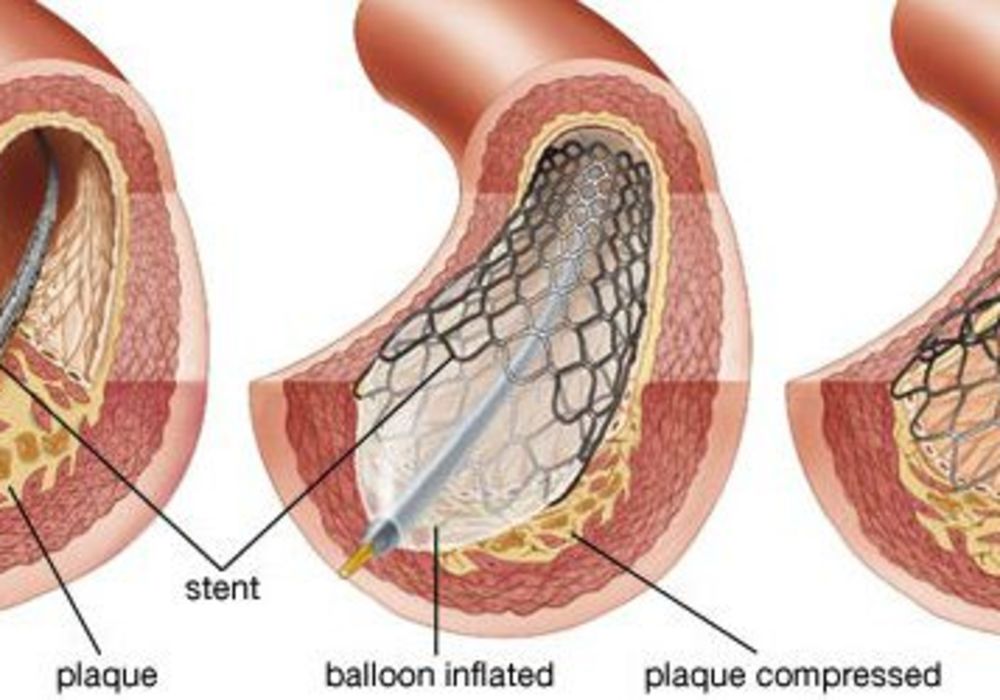 Effectiveness of Angioplasty Questioned for Treatment of CAD  