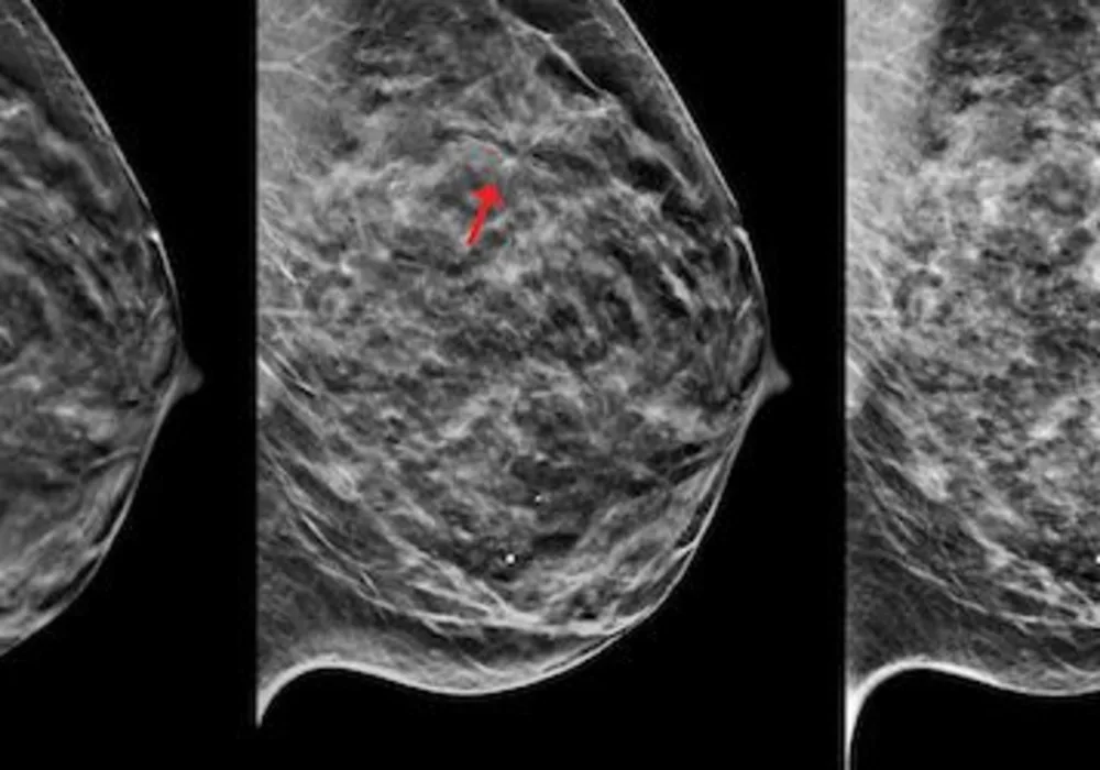 3D Mammography Named &lsquo;Hottest Clinical Procedure&rsquo; For The Fourth Consecutive Year