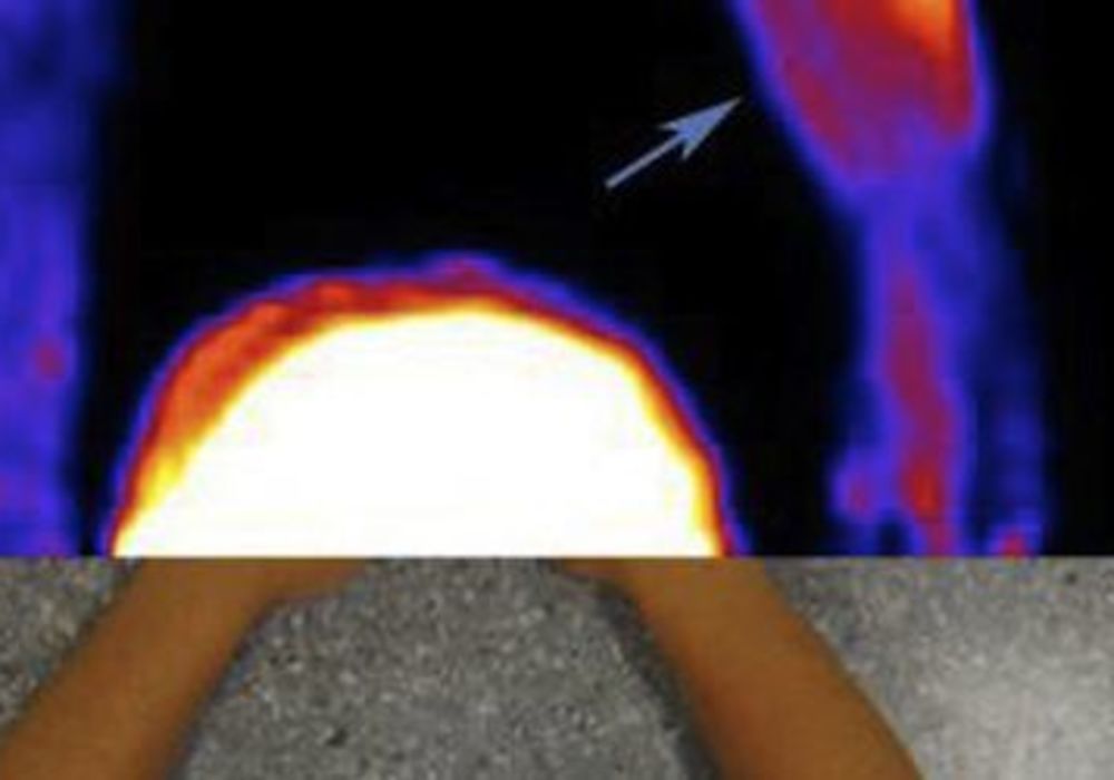 PET Scan Illuminates Tennis Elbow Pain Processes