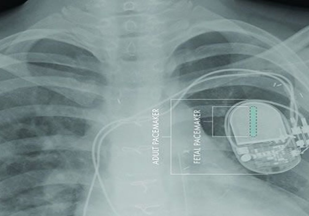 First Fully Implantable Micropacemaker for Foetal Use