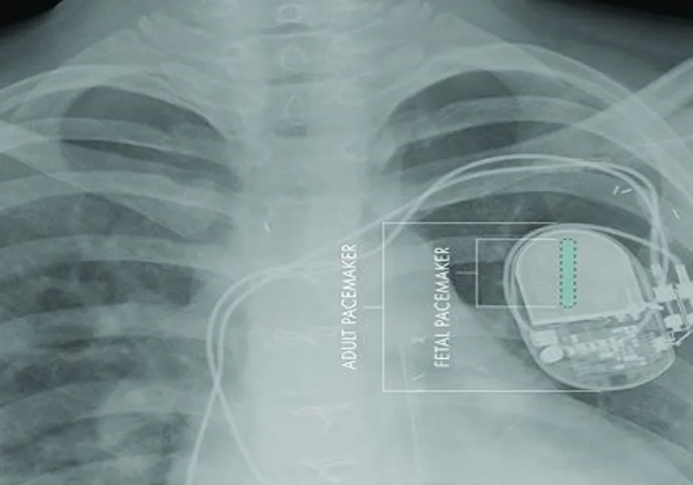 First Fully Implantable Micropacemaker for Foetal Use