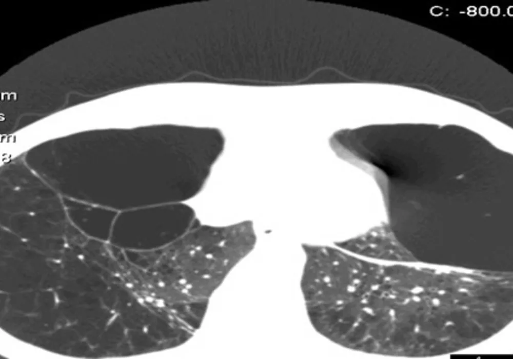 Advanced Image Processing for CT Lung Screening