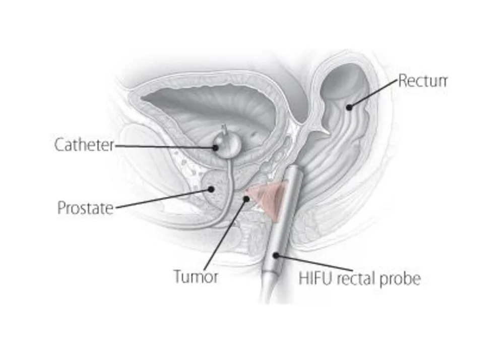 FDA Panel Disapproves Of HIFU For Prostate Cancer 