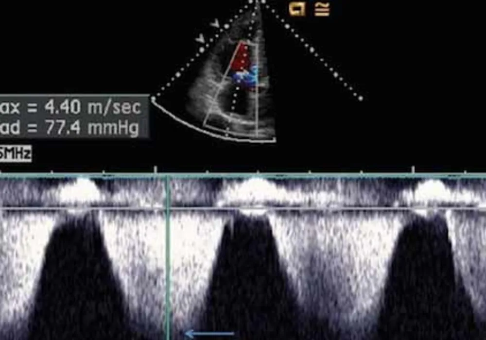 Measuring MPAP: Echocardiography Vs. Catheterisation 