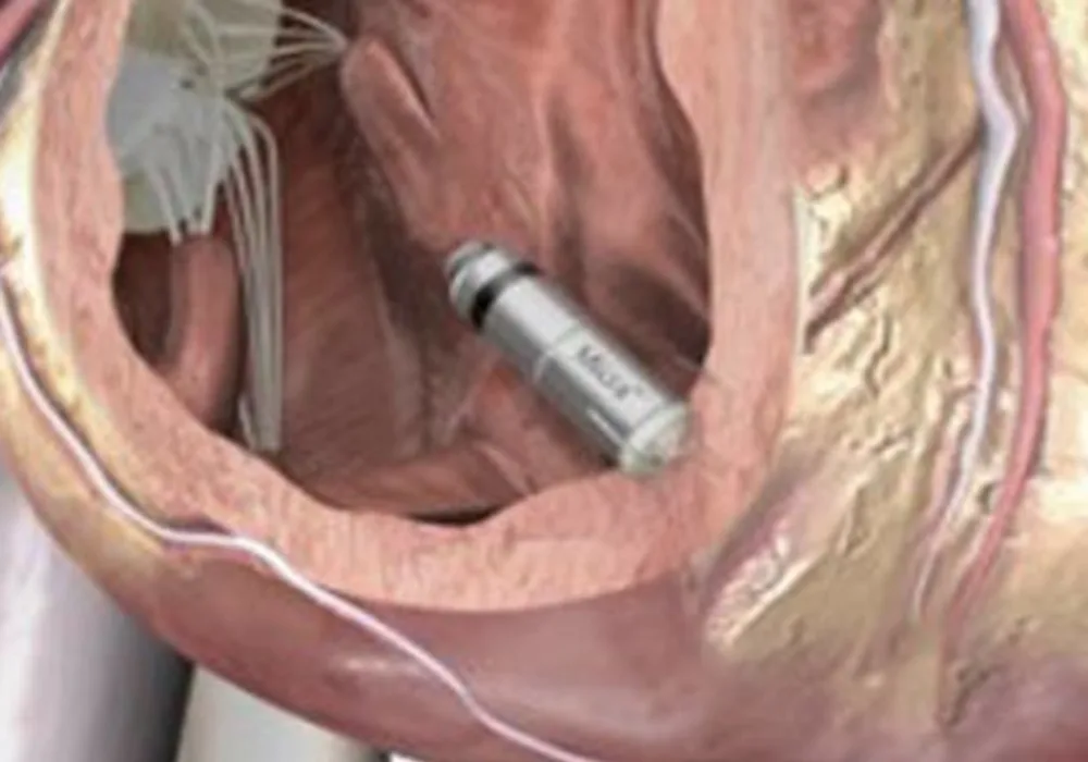 Leadless Pacemaker: Promising Potential