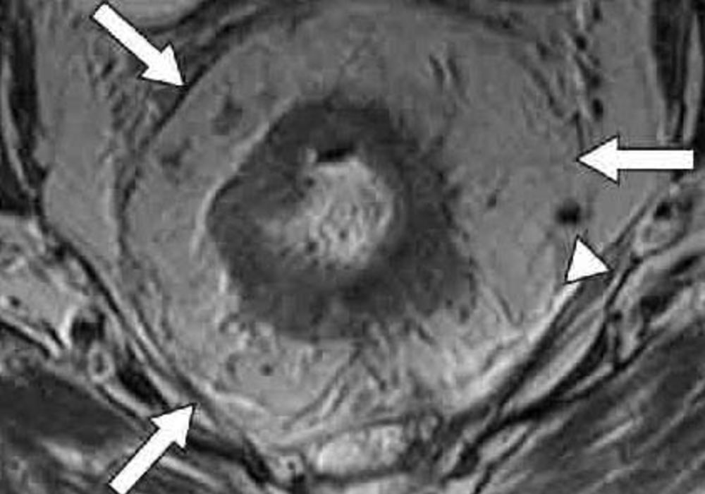 The Critical Role of Imaging in Colon and Rectal Cancer Management