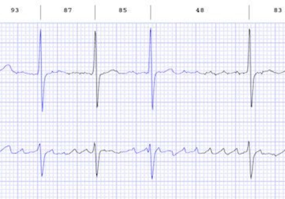 New Atrial Fibrillation Treatment Device