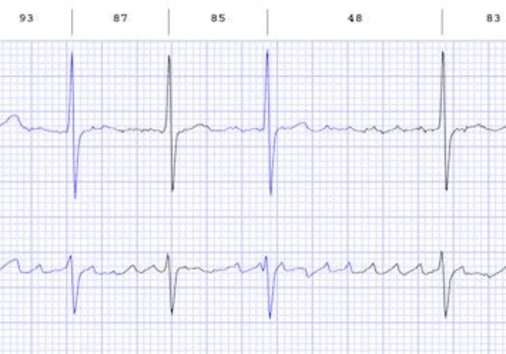 New Atrial Fibrillation Treatment Device