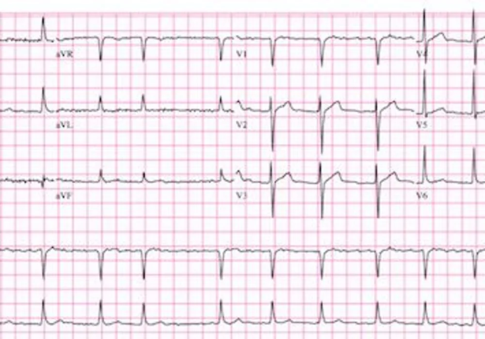 Atrial Fibrillation Seemingly Connected to Heart Attack Risk