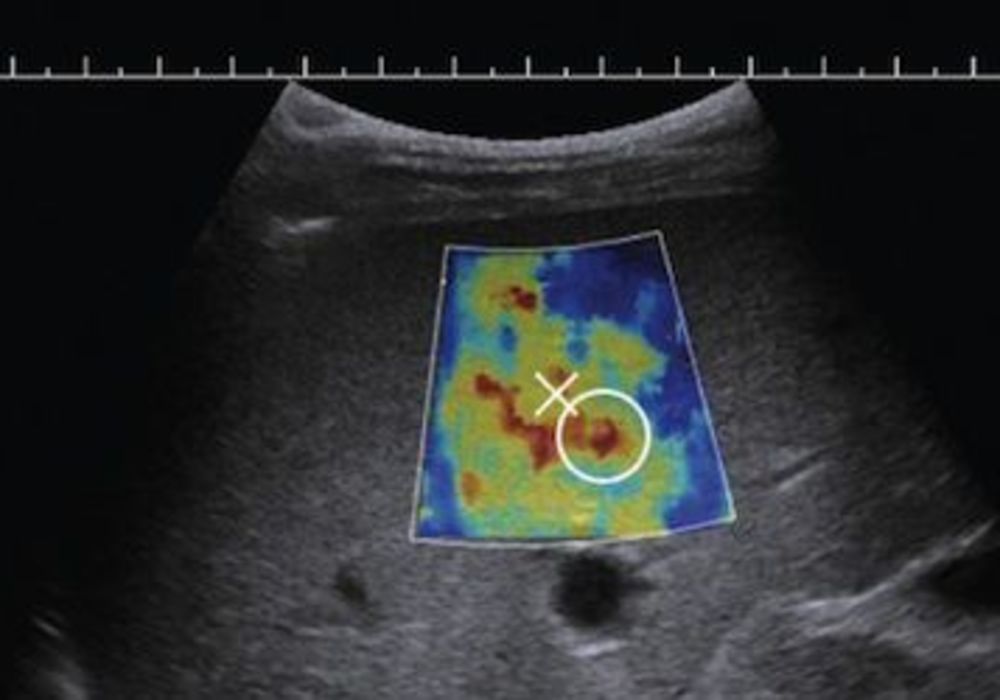 New Aixplorer Ultrasound System Allows For Non-Invasive Liver Fibrosis Measurement