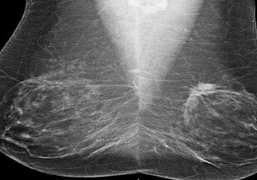 #RSNA14: Risk-Based Screening Misses Breast Cancers in Women in Their 40s