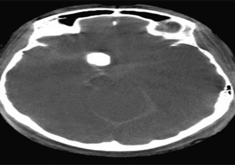 RSNA 2014: Siemens Introduces New Applications For Angiography