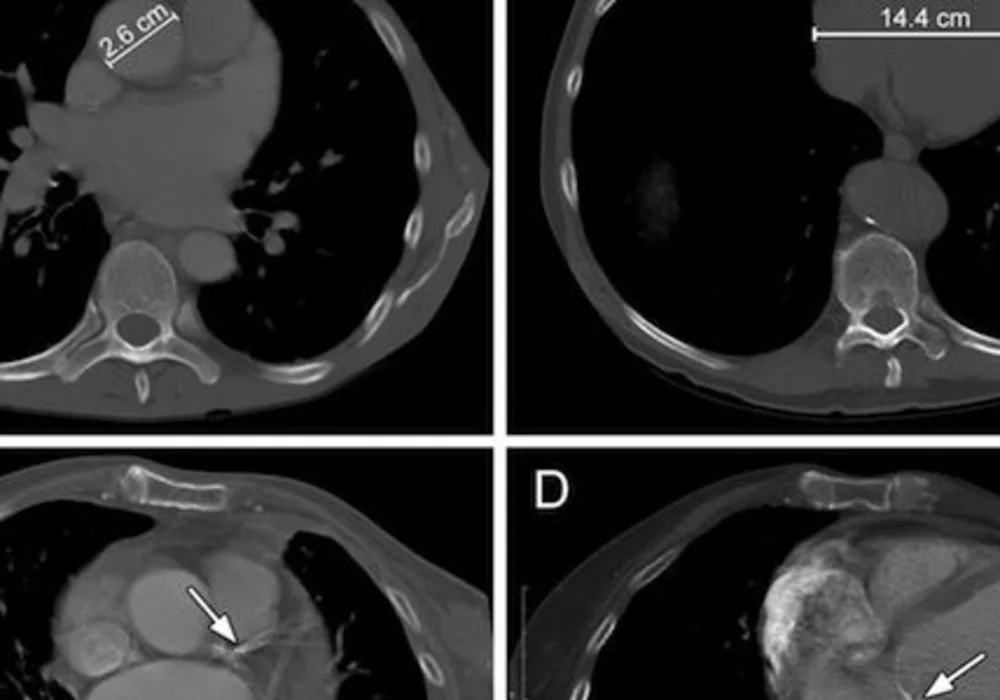 Chest CT Predicts Cardiovascular Risk