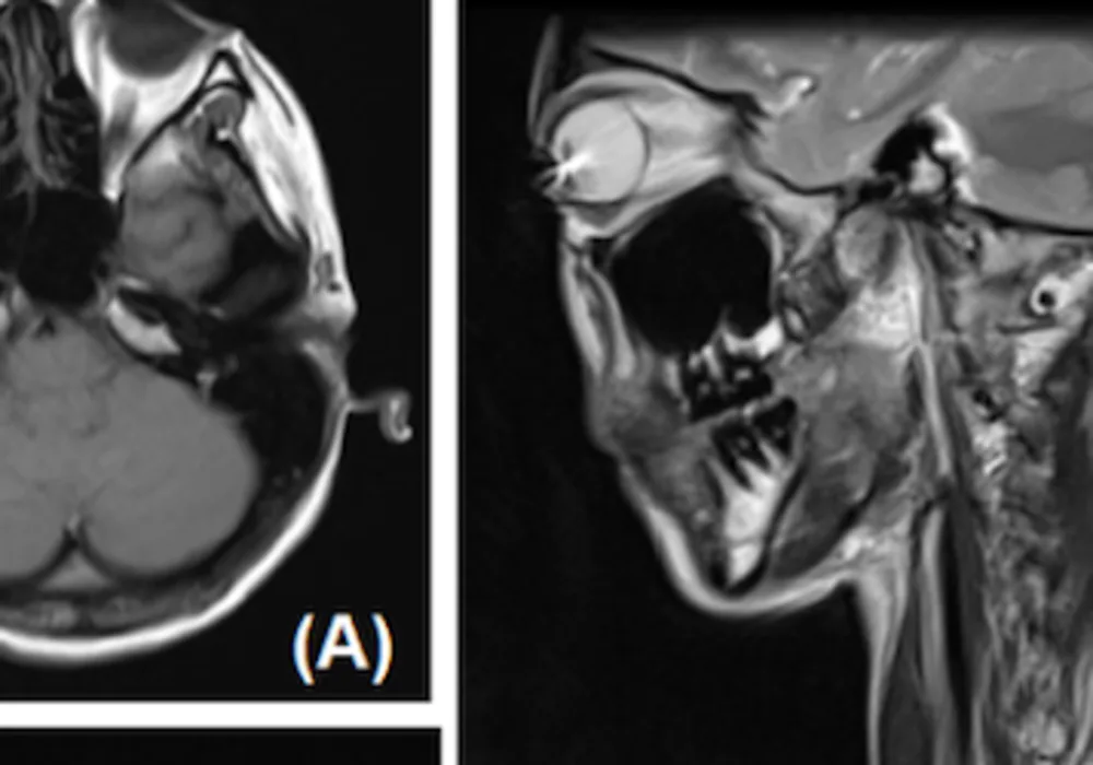 Circle Contact Lenses are Potential MRI Hazard