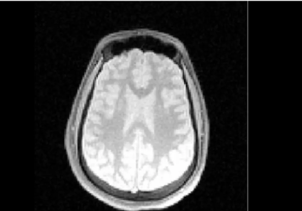 New MRI Method Fingerprints Tissues and Diseases 