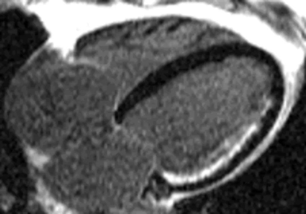 MRI Saves Heart Muscle 