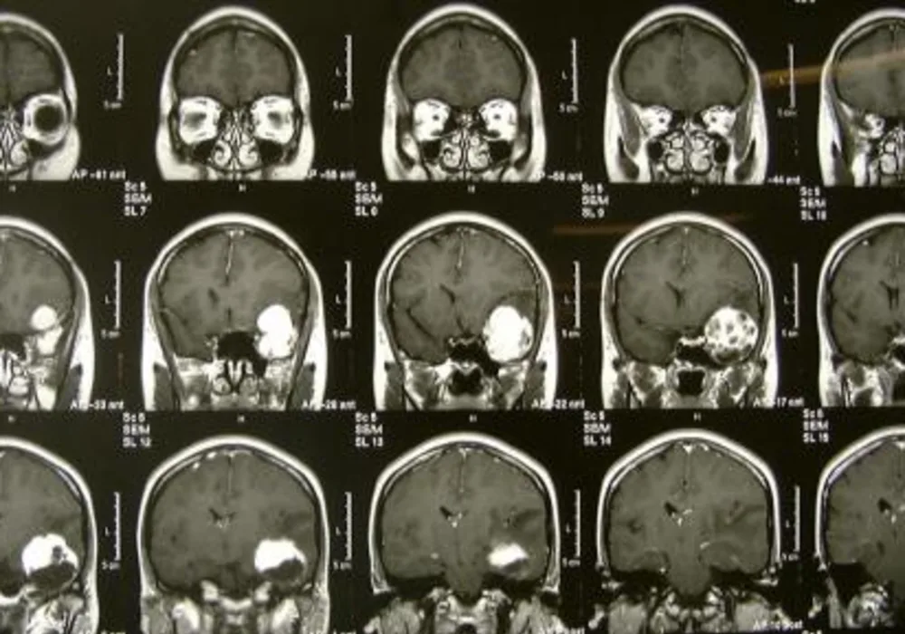 0280_Meningioma.jpg