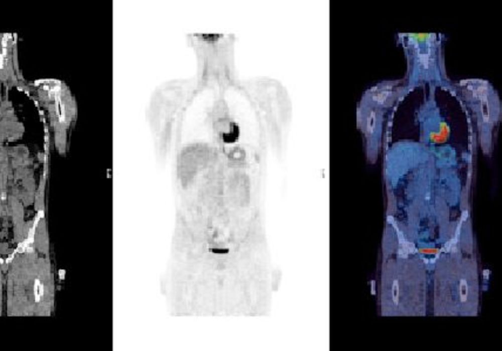 PET Scan after Chemo Could Avoid Need for Radiotherapy