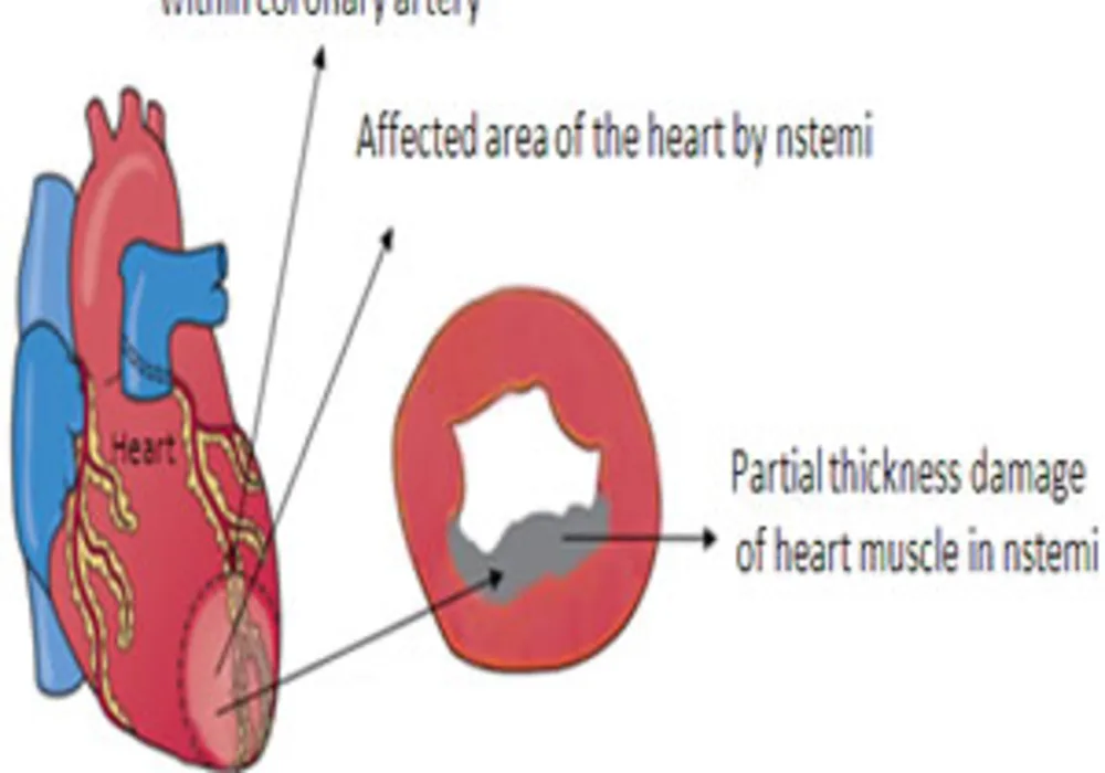 Atrial Fibrillation Increases Risk of NSTEMI