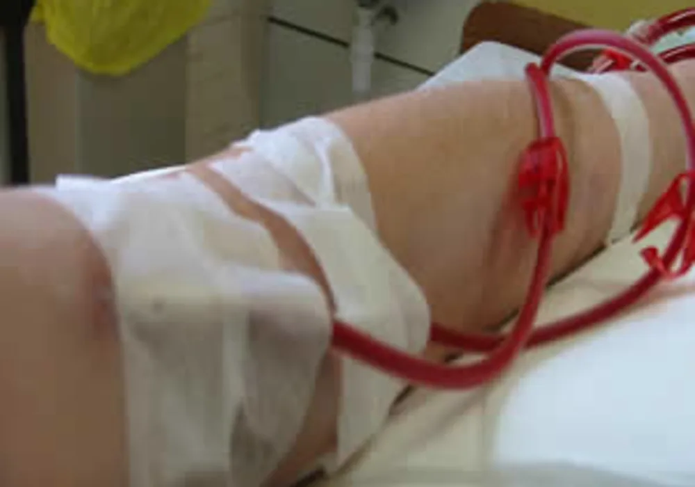 New Test Can Predict Sudden Cardiac Death in Haemodialysis Patients