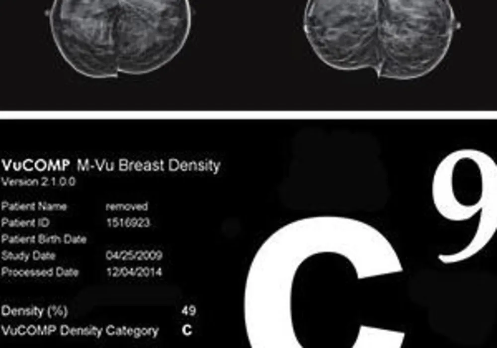 M-Vu&reg; Breast Density Software