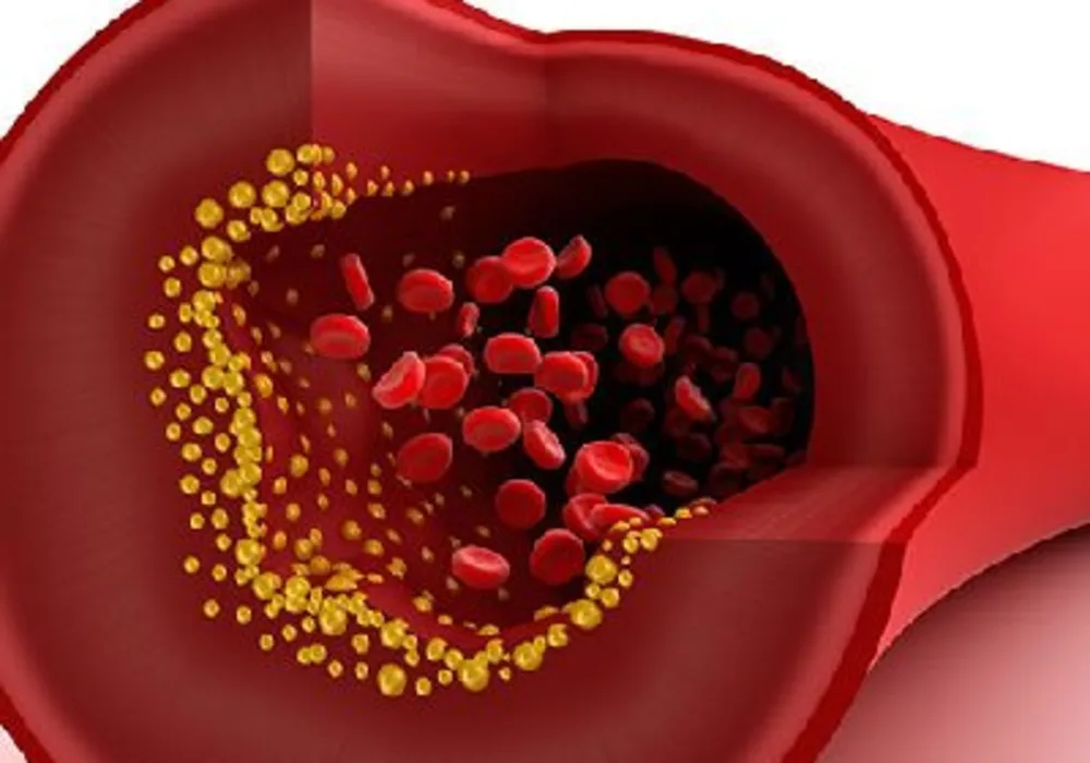 Risk of blood clots in post-surgical lung cancer patients