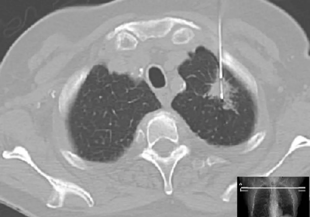 ESR/ERS New Lung Cancer Screening Recommendations