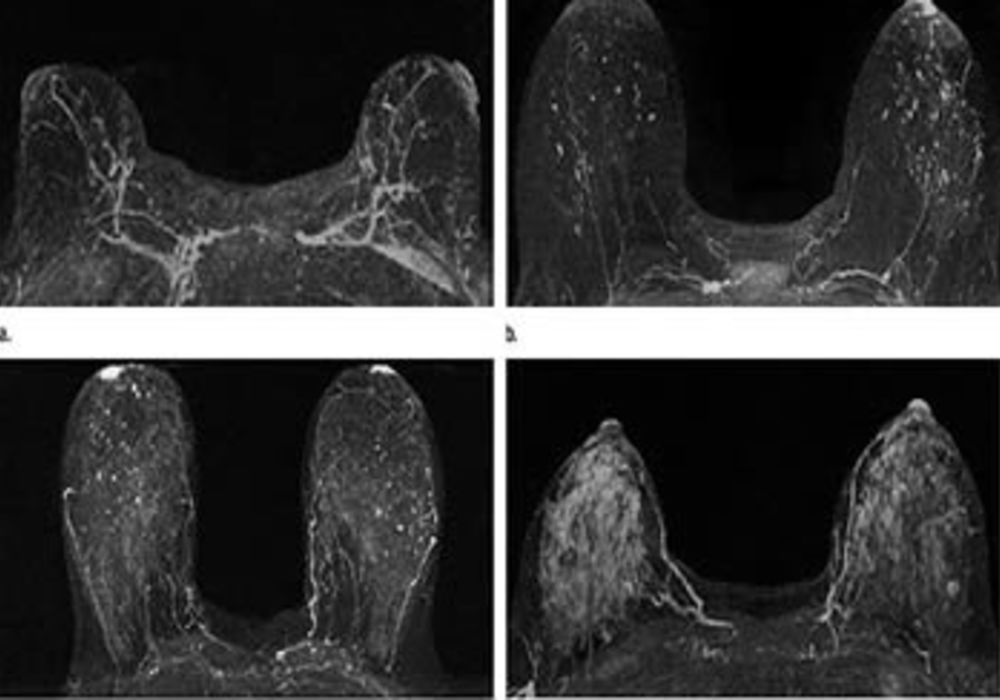 Could MRI Improve Breast Cancer Risk Prediction?