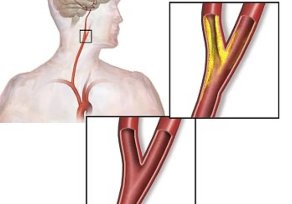 Variation in Carotid Artery Stenting Outcomes