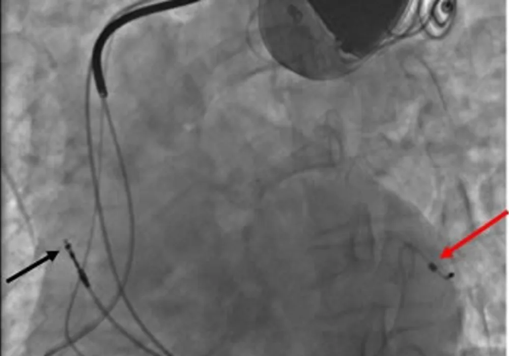Activity Following ICD Implantation Improves Survival