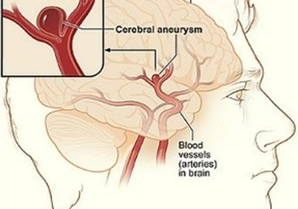 Cerebral aneurysm