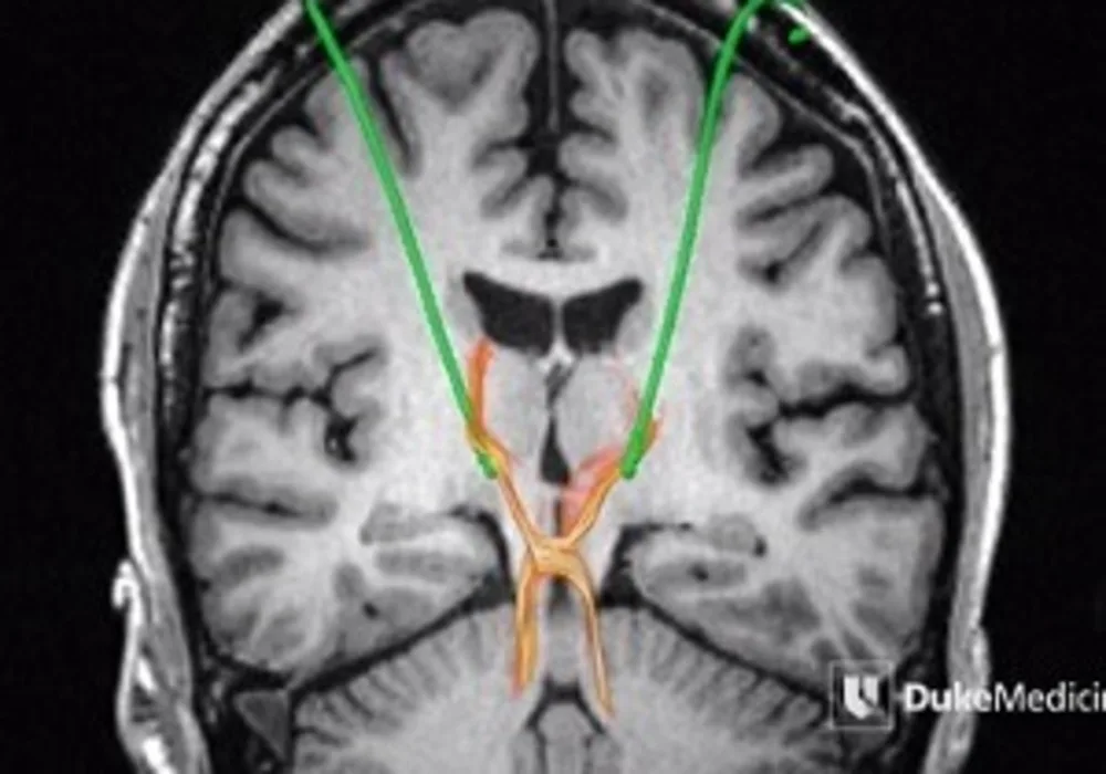 Dentatorubrothalamic tract (DRT)