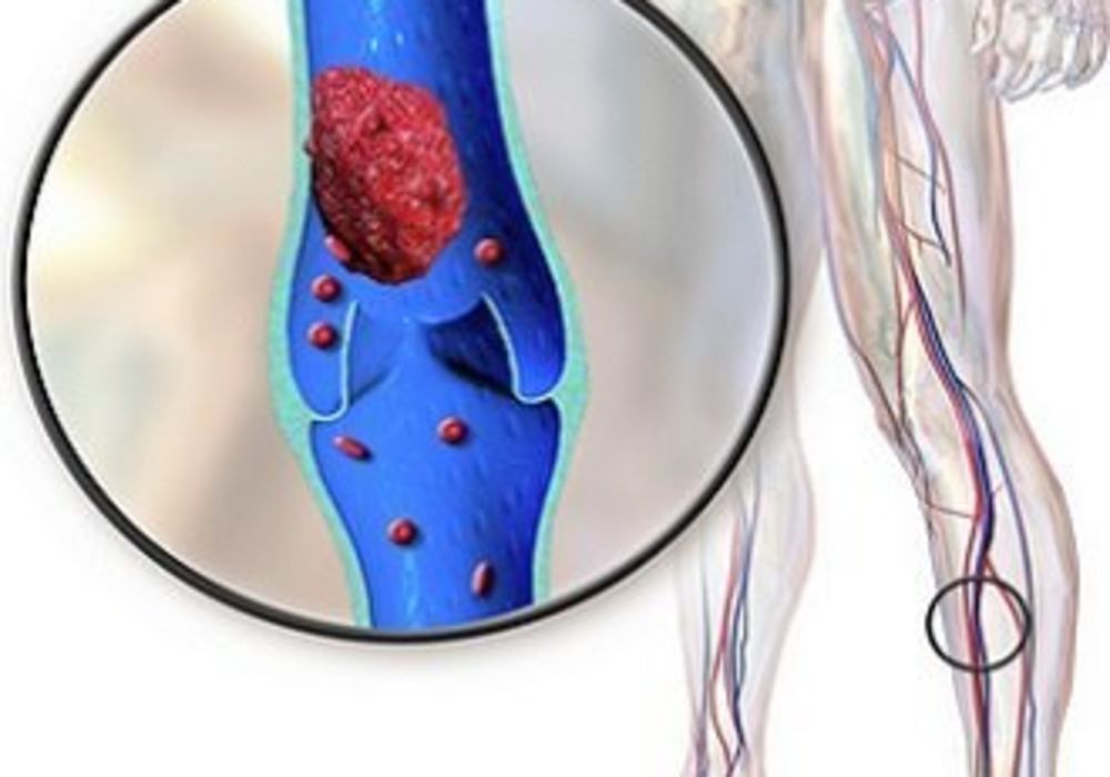 Deep vein thrombosis