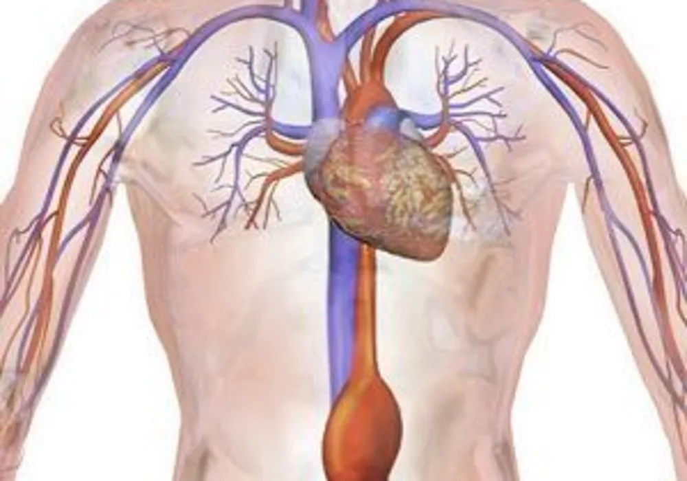 Drawing of an abdominal aortic aneurysm