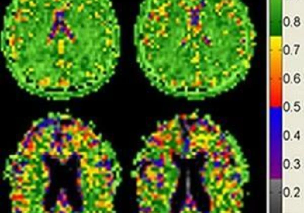 MRI: brain cell density