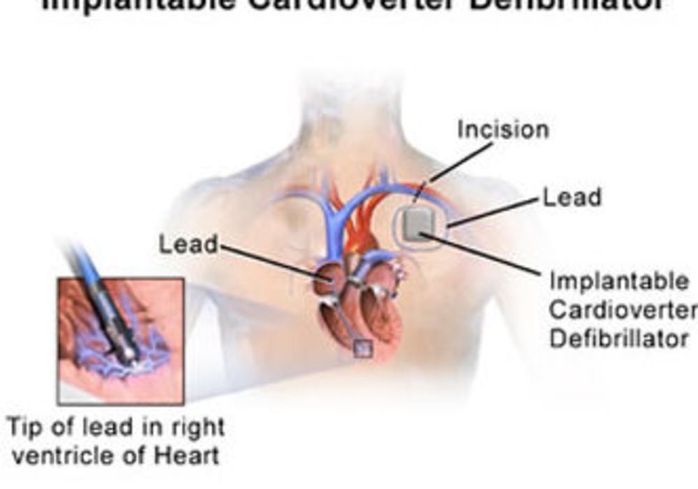 Implantable Cardioverter Defibrillator