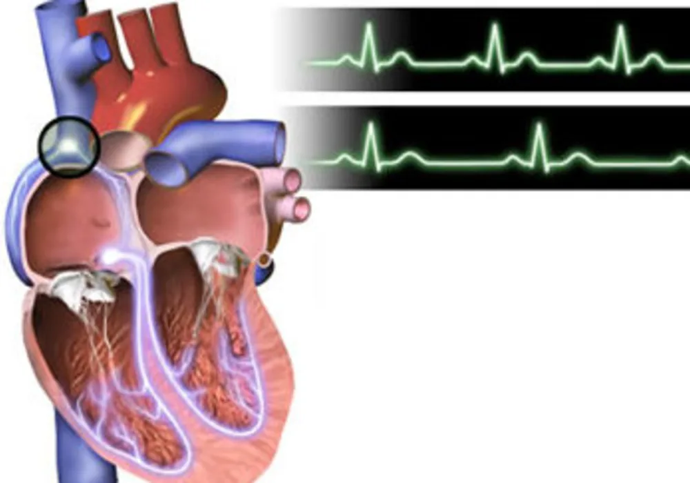 Bradycardia