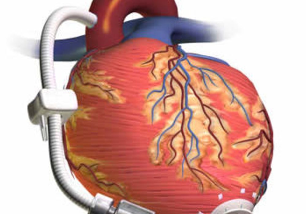 LVAD