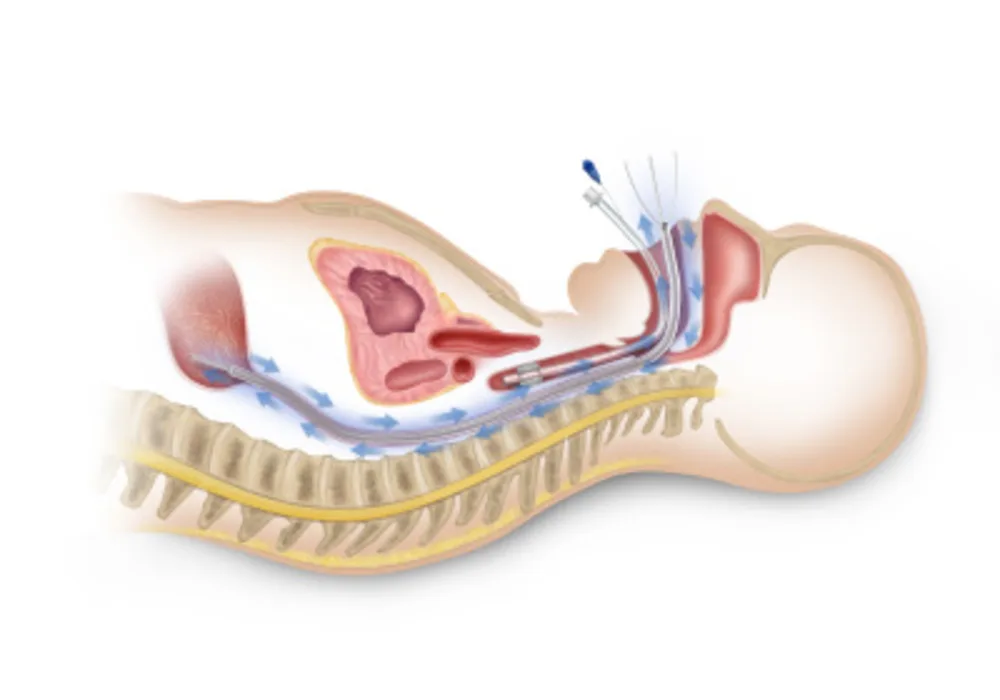 Advanced Cooling Therapy Receives FDA Clearance for Esophageal Cooling Device