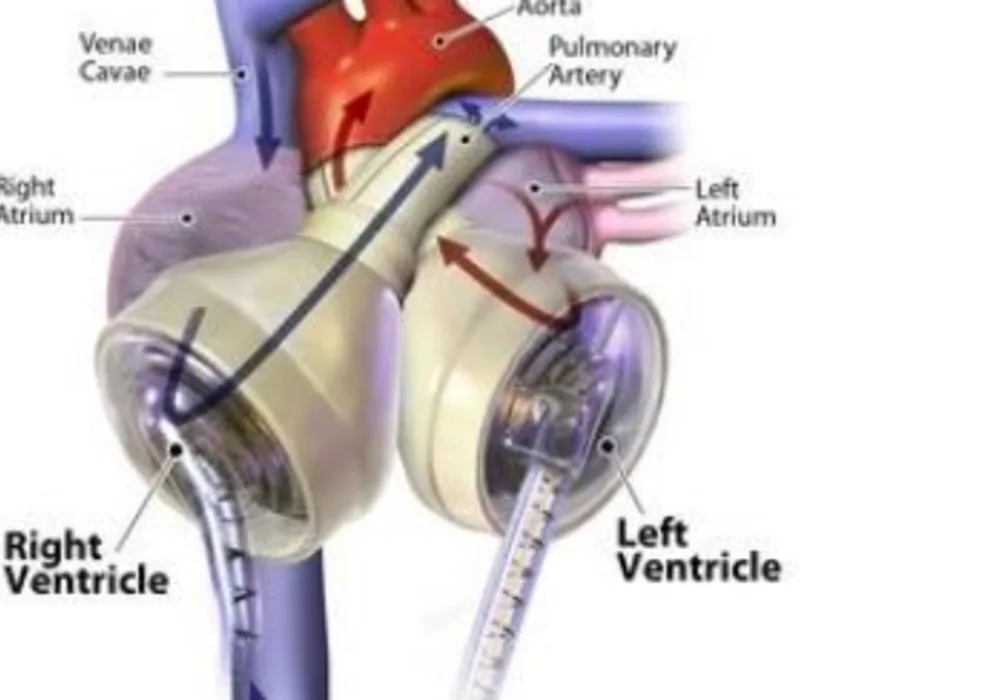 The Syncardia Total Artificial Heart 